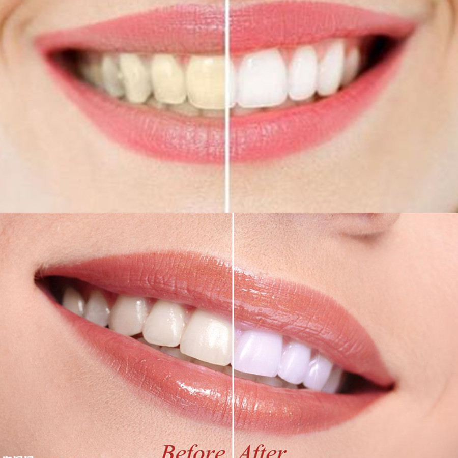 Than Tre Răng Răng Nha Khoa De - đánh giá và giá Teeth Whitening Singapore