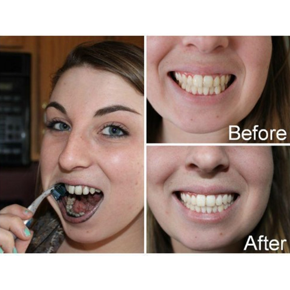Than Tre Răng Răng Nha Khoa De - đánh giá và giá Teeth Whitening Singapore