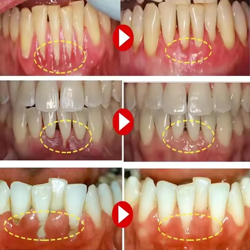 Teeth Whitening Gel Gum Repair - đánh giá và giá Teeth Whitening Gels