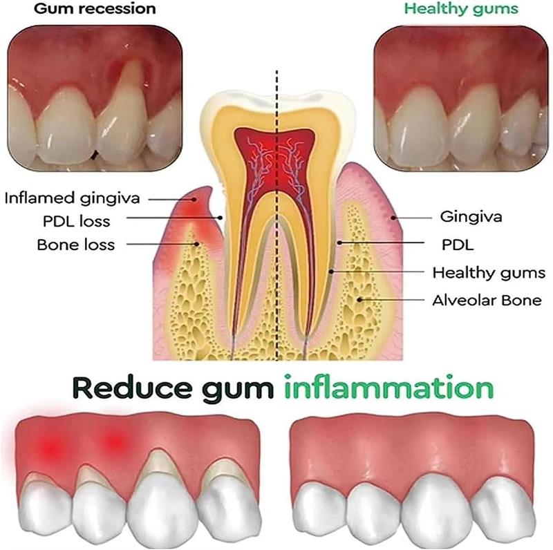 Teeth Whitening Gel Gum Repair - đánh giá và giá Teeth Whitening Gels