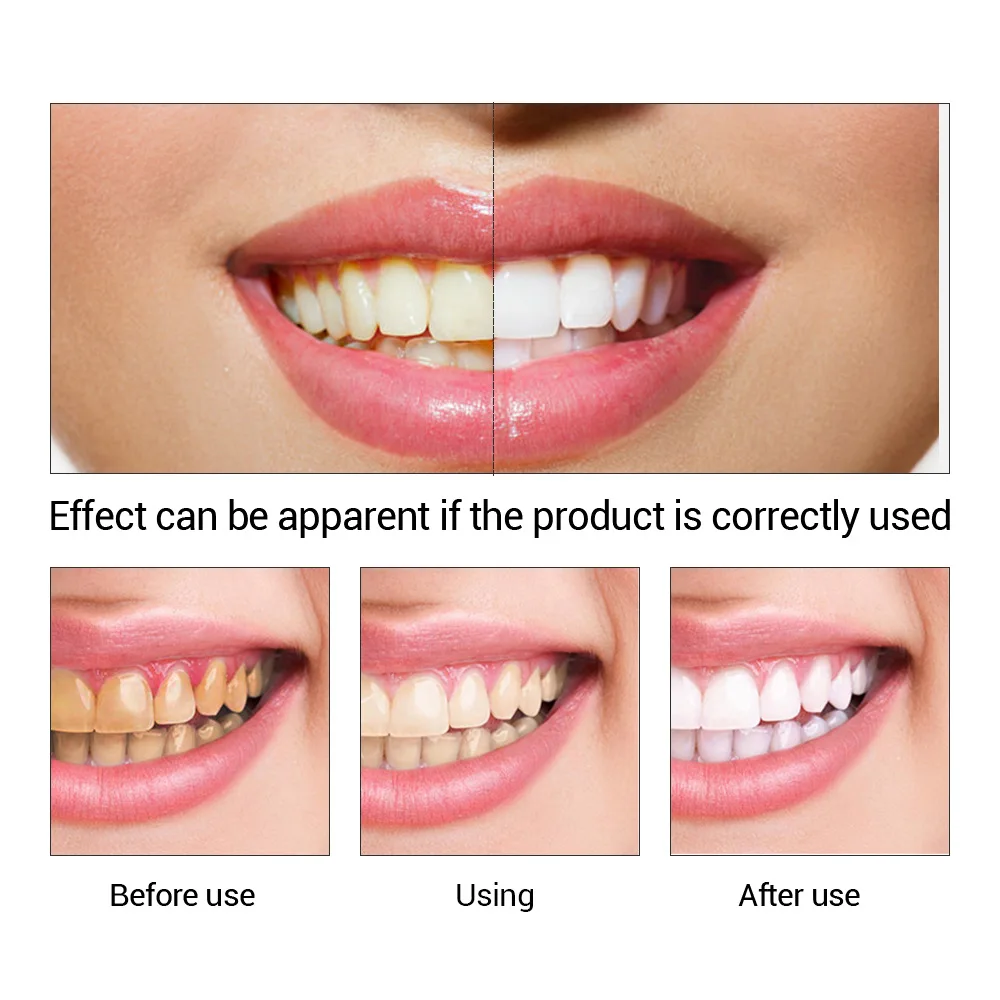 FTEENPLY Làm Trắng Răng Tinh C - đánh giá và giá Teeth Whitening Singapore