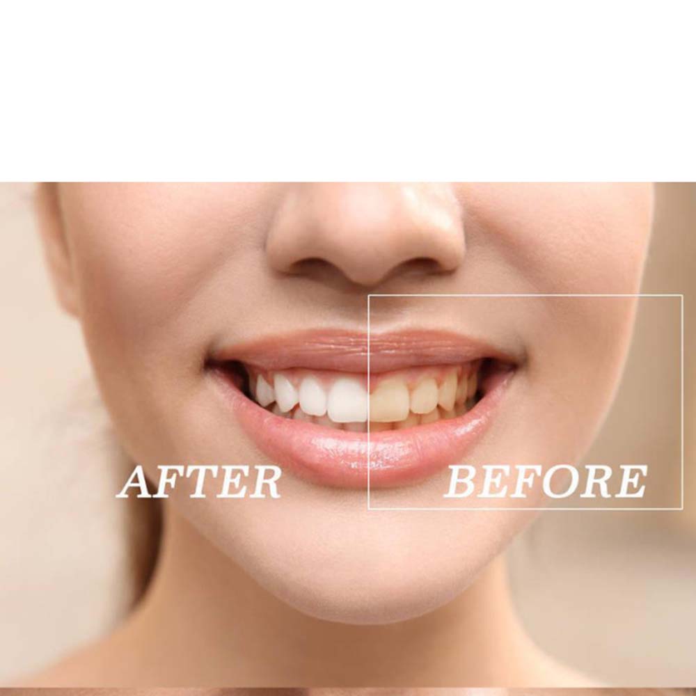 Chất Lượng Hàng Đầu Peroxide L - đánh giá và giá Teeth Whitening Gels