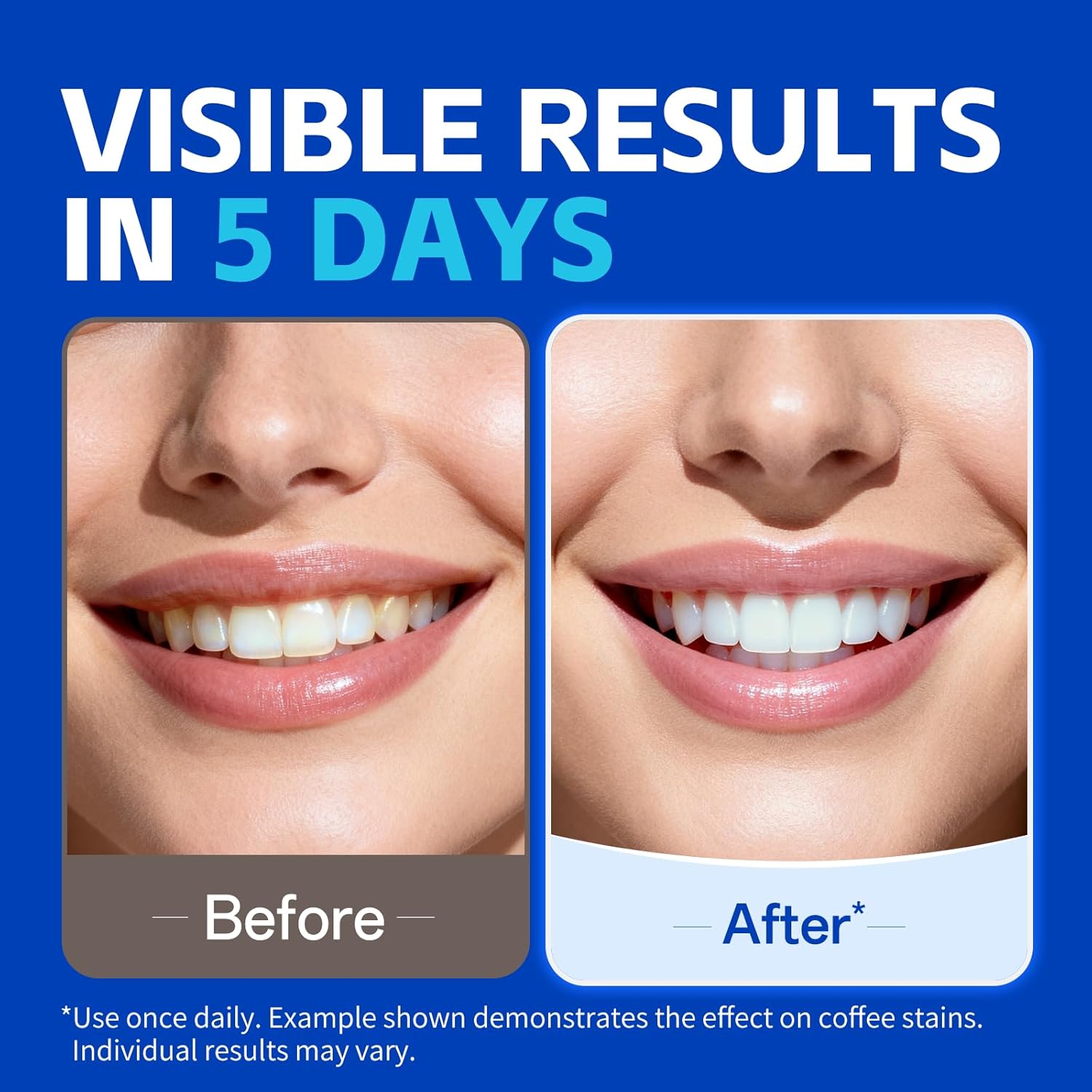 KHAZIX Teeth Whitening Strips  - đánh giá và giá Teeth Whitening Oil Pulling